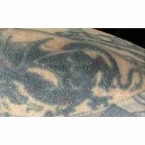 Лазерное удаление татуировок и татуажа (PicoSure by Cynosure)