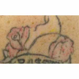 Лазерное удаление татуировок и татуажа (PicoSure by Cynosure)