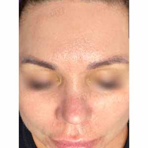 Комплексная чистка HydraFacial