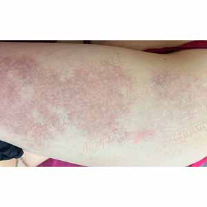 Vbeam Perfecta Candela
