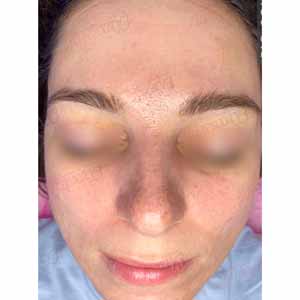 Комплексная чистка HydraFacial