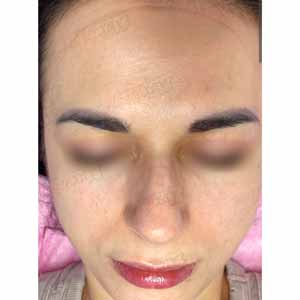 Комплексная чистка HydraFacial
