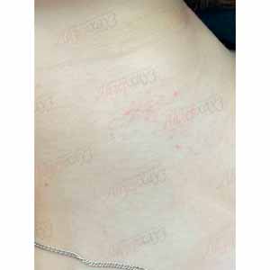 Vbeam Perfecta Candela