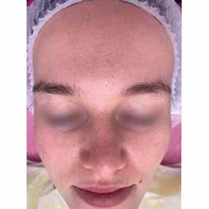 Комплексная чистка HydraFacial
