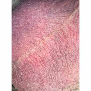 Лазерное лечение розацеа в Киеве - Фото После - №37