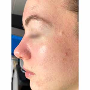 Комплексная чистка HydraFacial