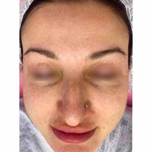 Комплексная чистка HydraFacial