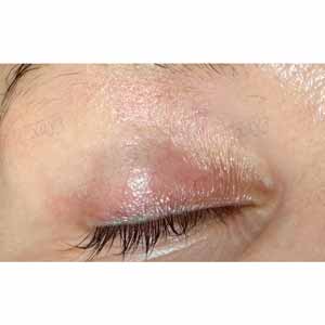 Vbeam Perfecta Candela