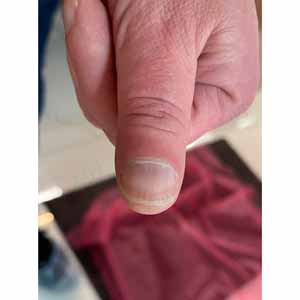 Лазерное лечение ногтевого грибка