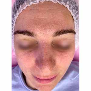 Комплексная чистка HydraFacial