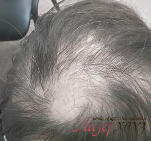 Мезотерапия для волос дома — миф или реальность?