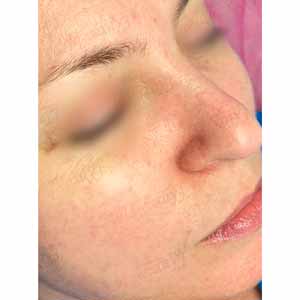 Комплексная чистка HydraFacial