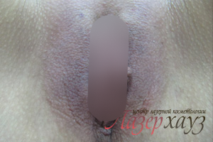 Контурная пластика половых губ в Харькове - Фото После - №6