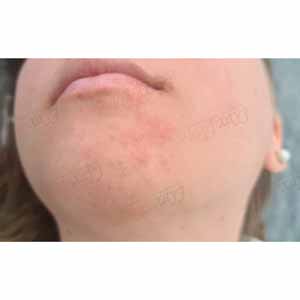 Vbeam Perfecta Candela
