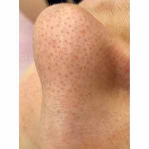 Комплексная чистка HydraFacial