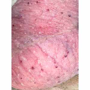 Лазерное лечение розацеа в Киеве - Фото До - №37