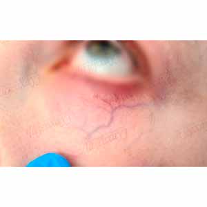 Vbeam Perfecta Candela