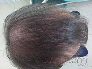 Лечение волос (возобновление роста волос)