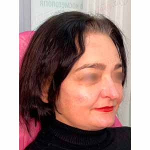 Волюмизация Radiesse и Facetem S - Фото После - №9