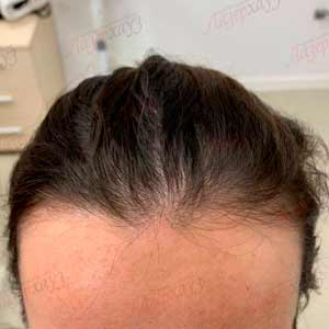 Регенерация волос Regenera
