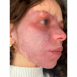 Vbeam Perfecta Candela