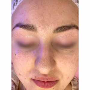 Комплексная чистка HydraFacial