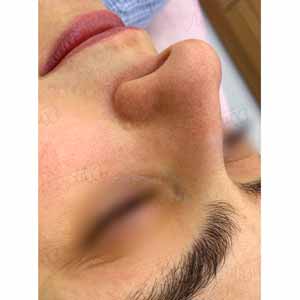 Комплексная чистка HydraFacial
