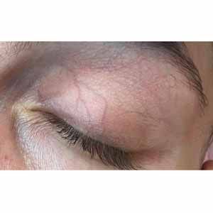 Vbeam Perfecta Candela