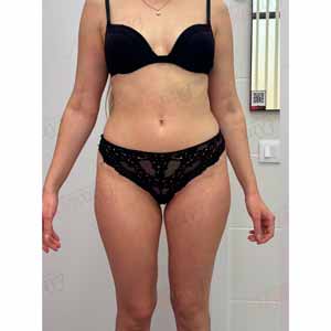 Віскі-сповивання у Василькові - Фото До - №1333