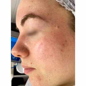 Комплексная чистка HydraFacial