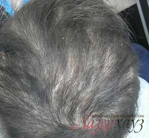 Лечение волос (возобновление роста волос)