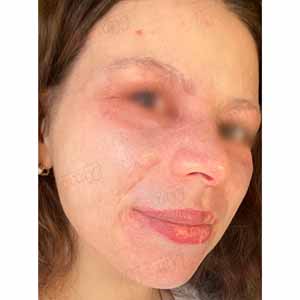 Vbeam Perfecta Candela