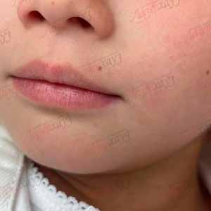 Лазерное удаление родимих плям детям (PicoSure by Cynosure)