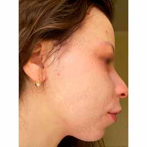 Vbeam Perfecta Candela