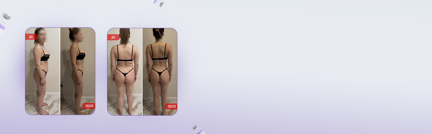 Плазмолифтинг в виннице