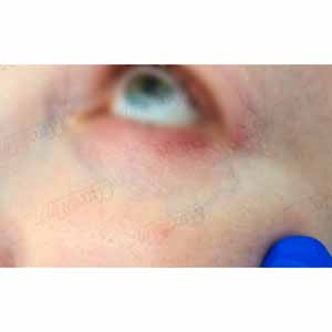 Vbeam Perfecta Candela