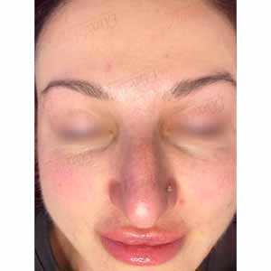 Комплексная чистка HydraFacial