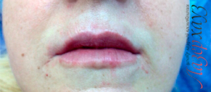 Контурная пластика кисетных морщин над верхней губой и щек