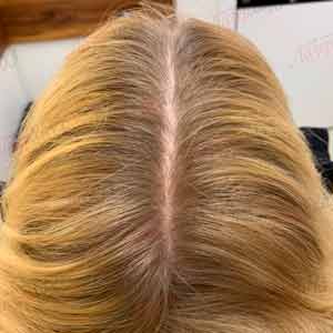 Регенерация волос Regenera