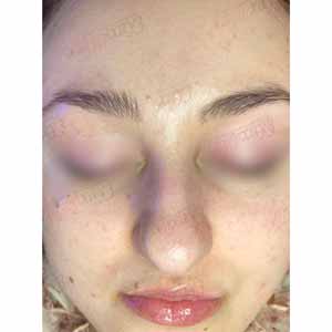 Комплексная чистка HydraFacial