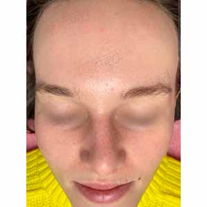 Комплексная чистка HydraFacial