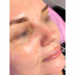 Комплексная чистка HydraFacial