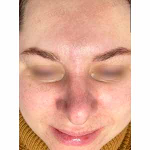Комплексная чистка HydraFacial