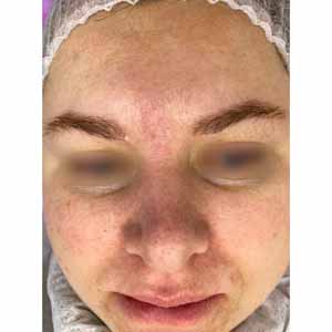 Комплексная чистка HydraFacial