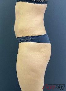 Coolsculpting by Zeltiq