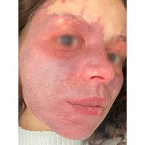 Vbeam Perfecta Candela