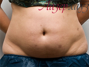 Coolsculpting by Zeltiq