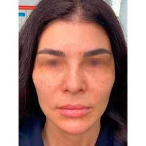 Волюмизация Radiesse и Facetem S - Фото После - №4