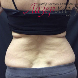 Coolsculpting by Zeltiq