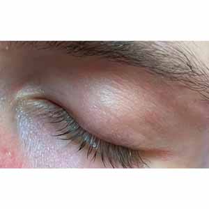 Vbeam Perfecta Candela